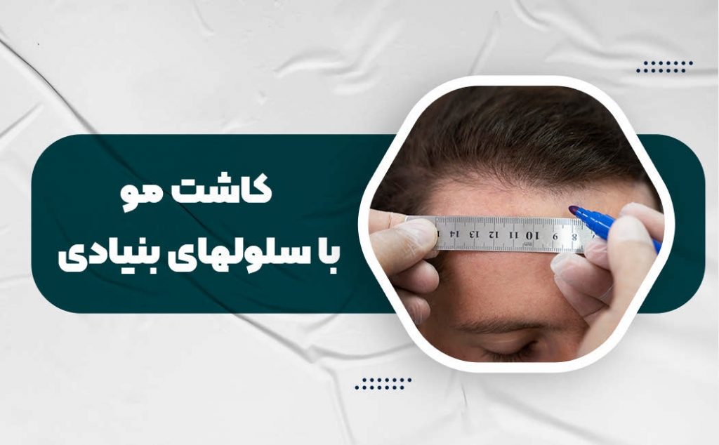 کاشت مو با سلول‌های بنیادی