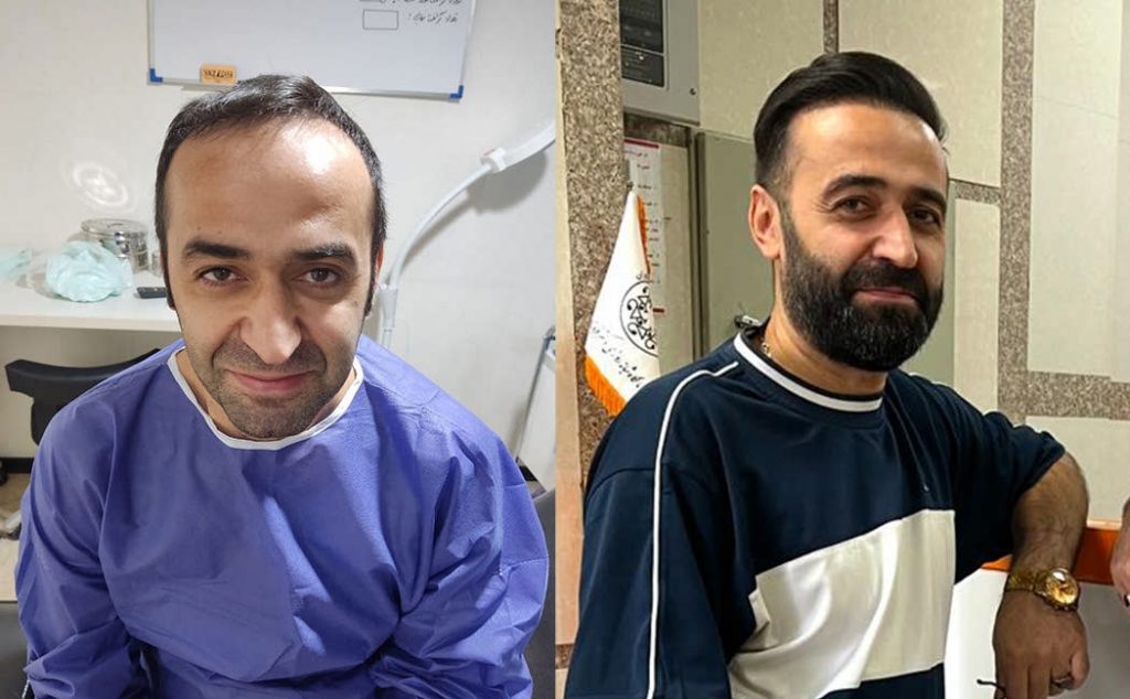 نمونه کاشت مو در کلینیک بلوط
