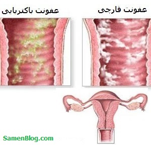 عفونت های واژن دستگاه تناسلی زنان